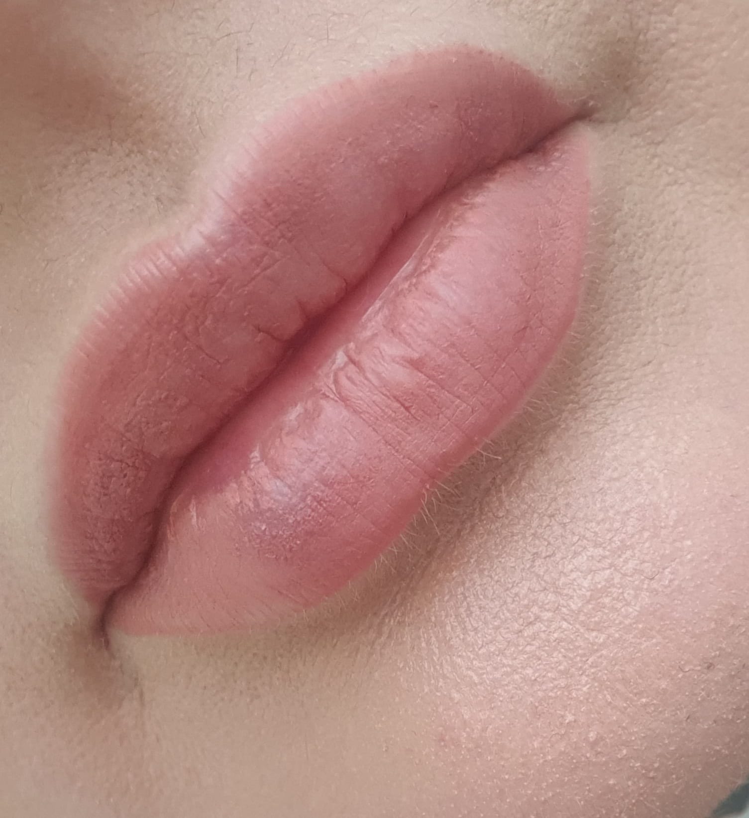 Hyaluron bei Lippen
